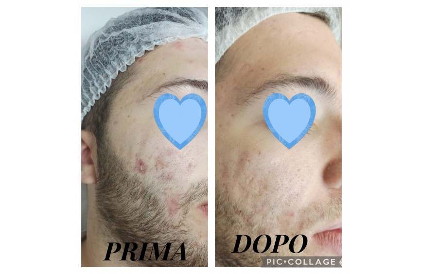 PELLE GRASSA? 3 SEMPLICI STEP PER TRATTARLA!