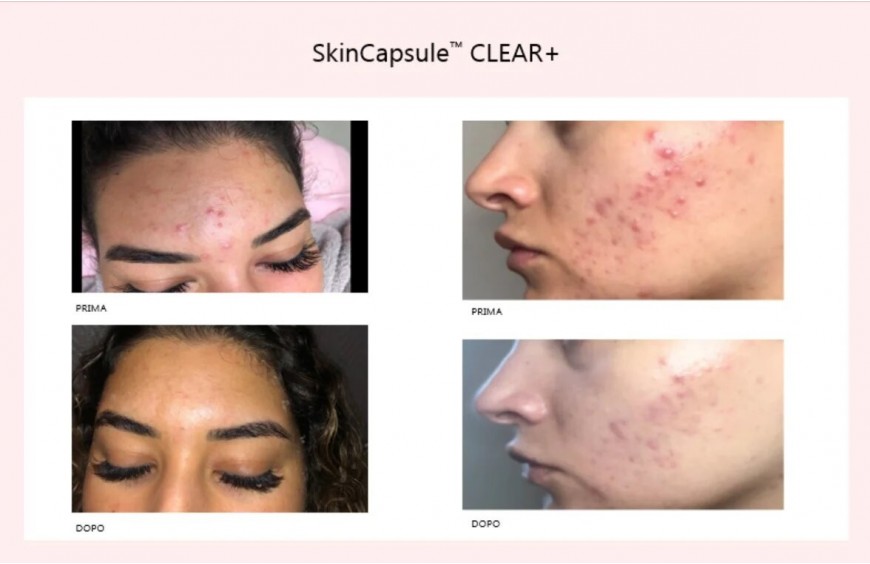 ACNE, un approccio estetico e cosmetico integrato.