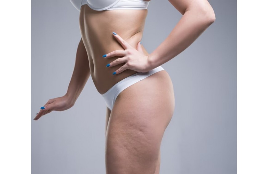 COS'E' LA CELLULITE? Cause, Sintomi e Rimedi