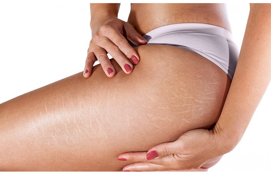 CEDIMENTI E SMAGLIATURE